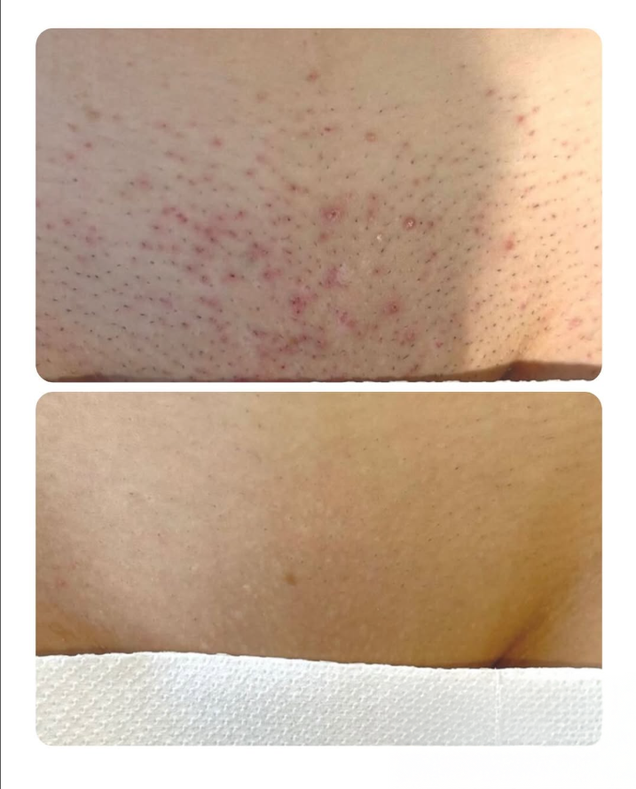 Bikini Area Treatment