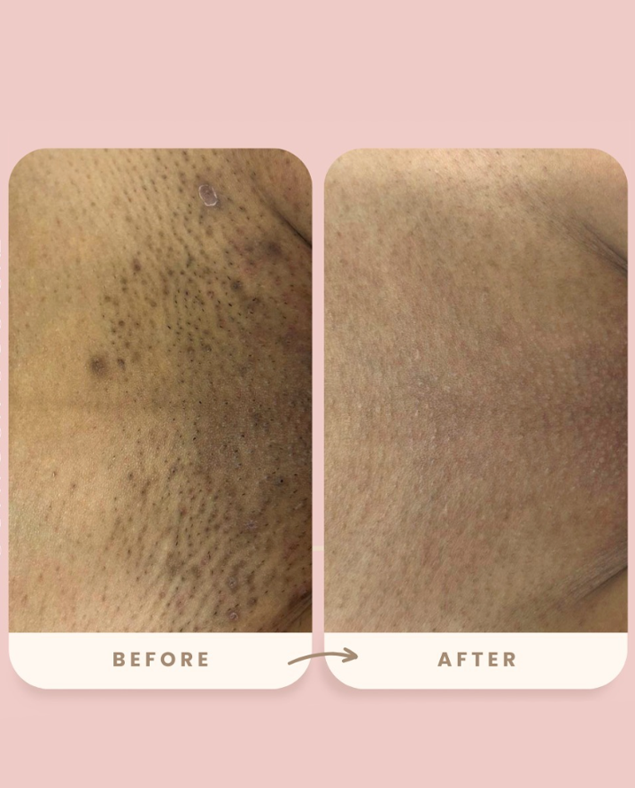 Bikini Area Result 2