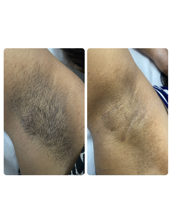 Underarms Treatment